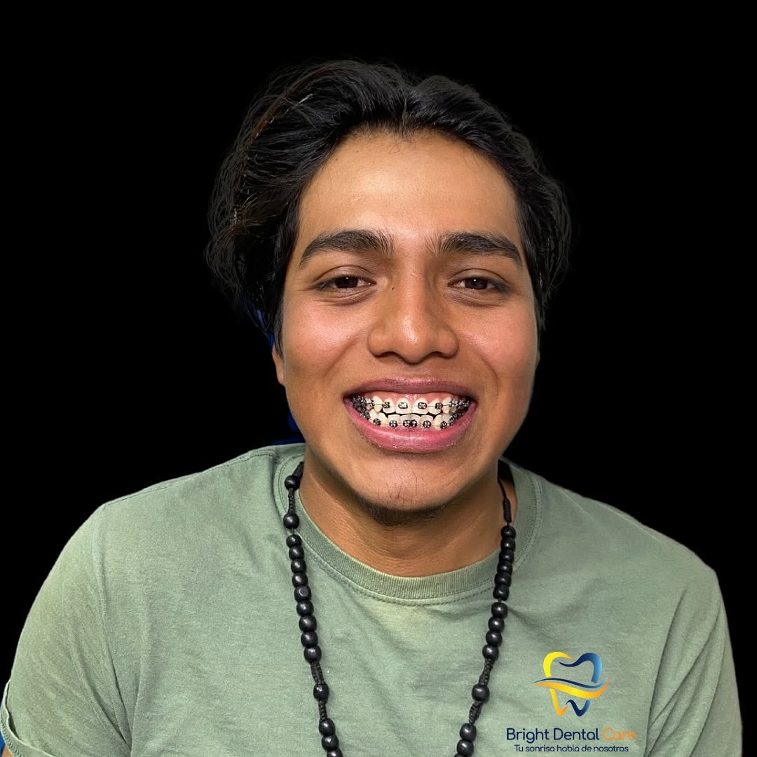 Resultado de diseño de sonrisa personalizado