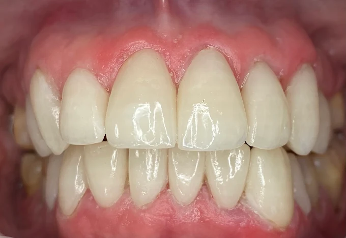 Resultado de tratamiento dental realizado en Bright Dental Care