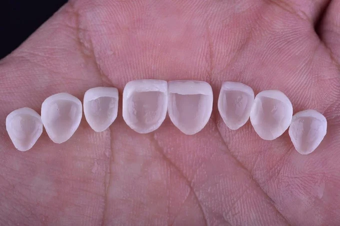 Resultado de tratamiento dental realizado en Bright Dental Care