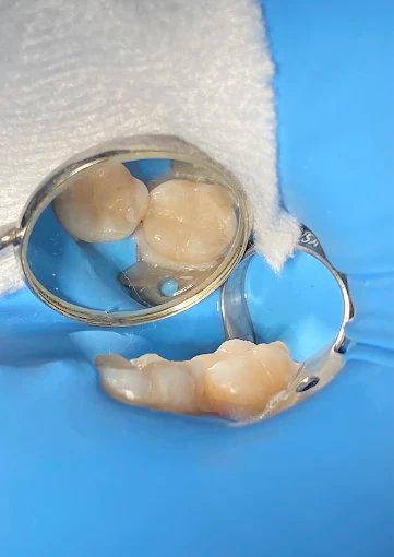 Resultado de tratamiento dental realizado en Bright Dental Care