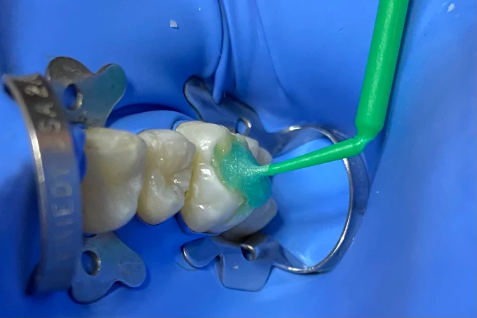 Resultado de tratamiento dental realizado en Bright Dental Care