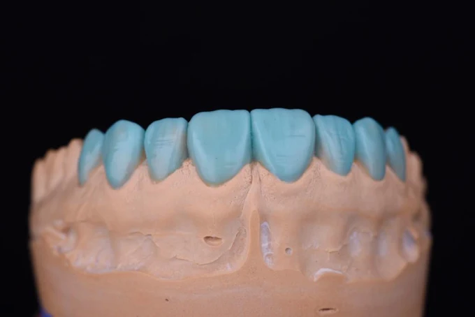 Resultado de tratamiento dental realizado en Bright Dental Care