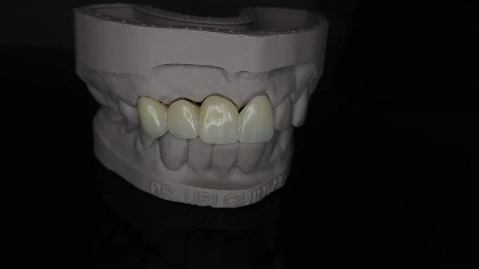 Resultado de tratamiento dental realizado en Bright Dental Care