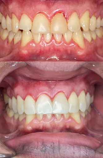 Resultado de tratamiento dental realizado en Bright Dental Care