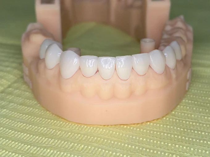 Resultado de tratamiento dental realizado en Bright Dental Care